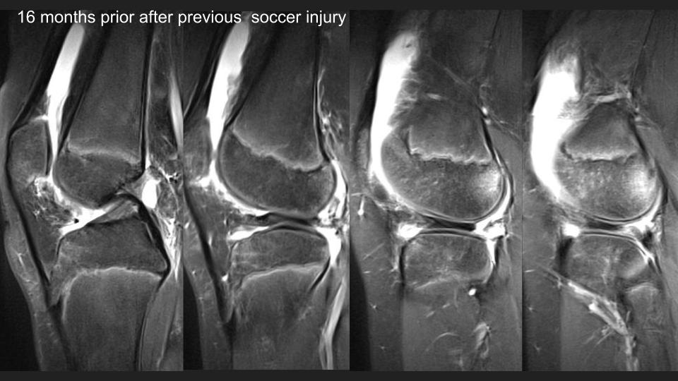 Figure 3 for case discoid lateral meniscus ( RID2771 )
